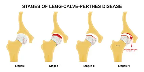 Legg Calve Perthes