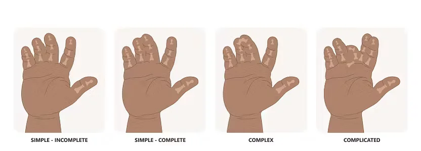 συνδακτυλια